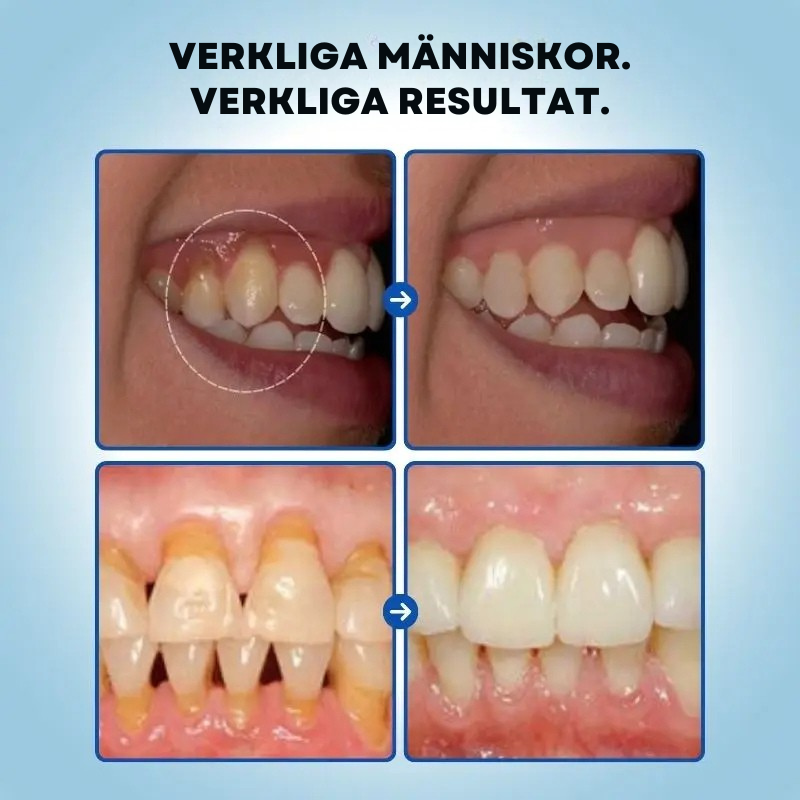 GumRelief™ | Lindrar tandkött & gerödning snabbt och effektivt