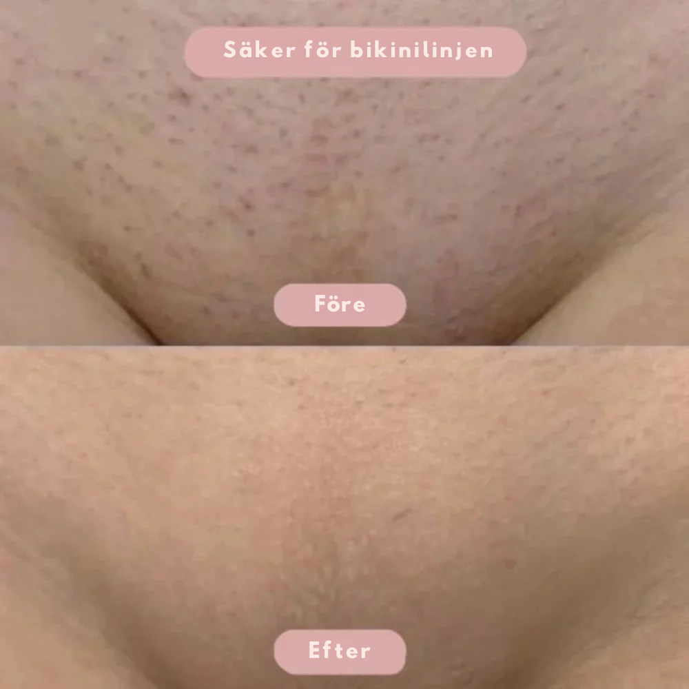 SmoothSkin™ | Intimbarbering uden irritation